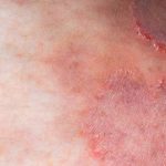 Alerta: Superfungo Trichophyton indotineae se Espalha Globalmente - Trichophyton indotineae