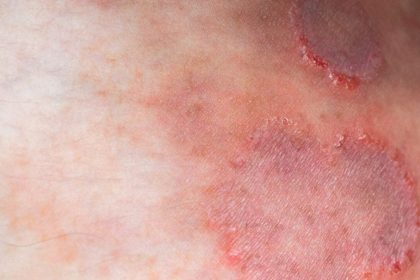 Alerta: Superfungo Trichophyton indotineae se Espalha Globalmente - Trichophyton indotineae